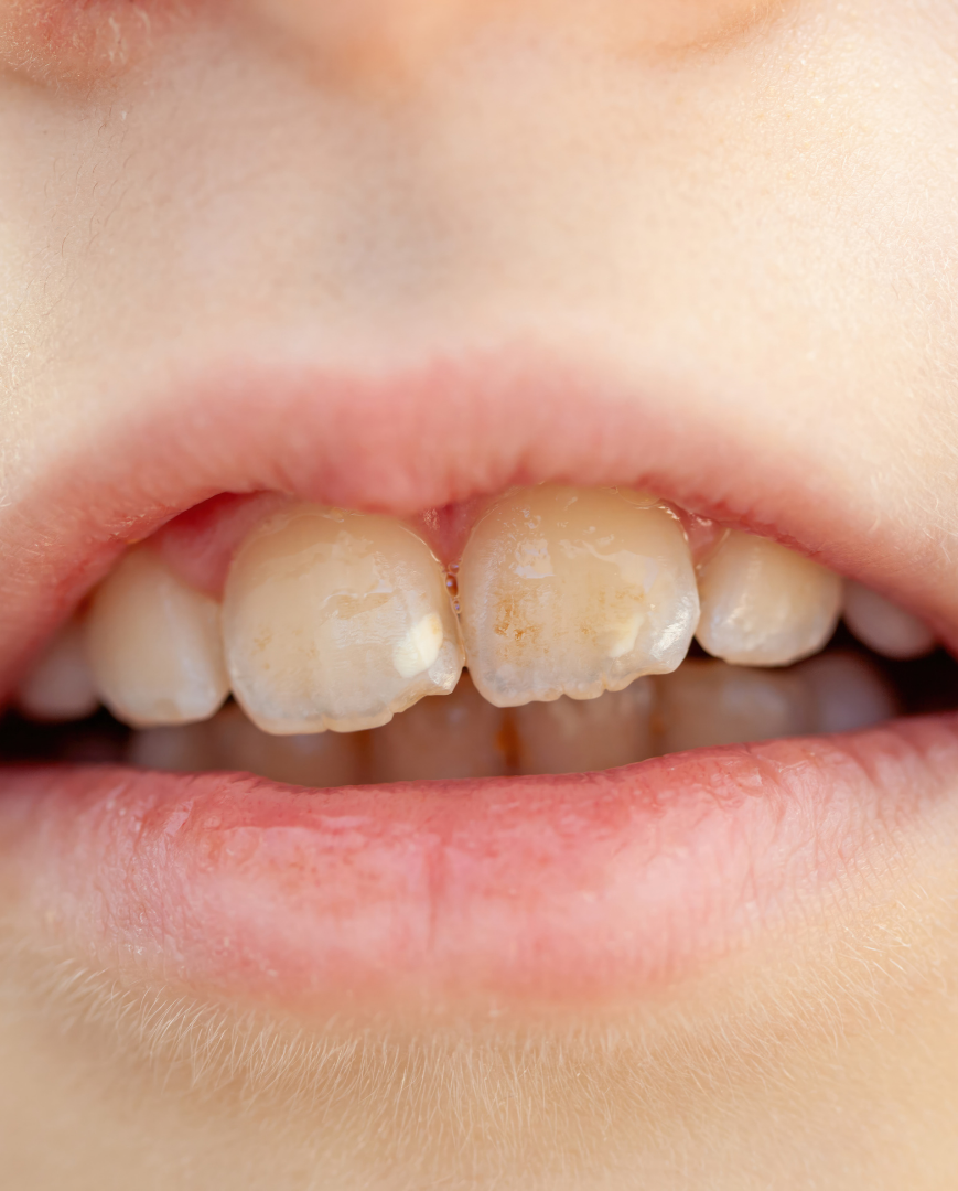 Clenching and Grinding