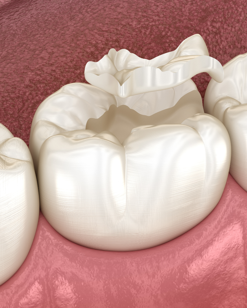 Composite Fillings