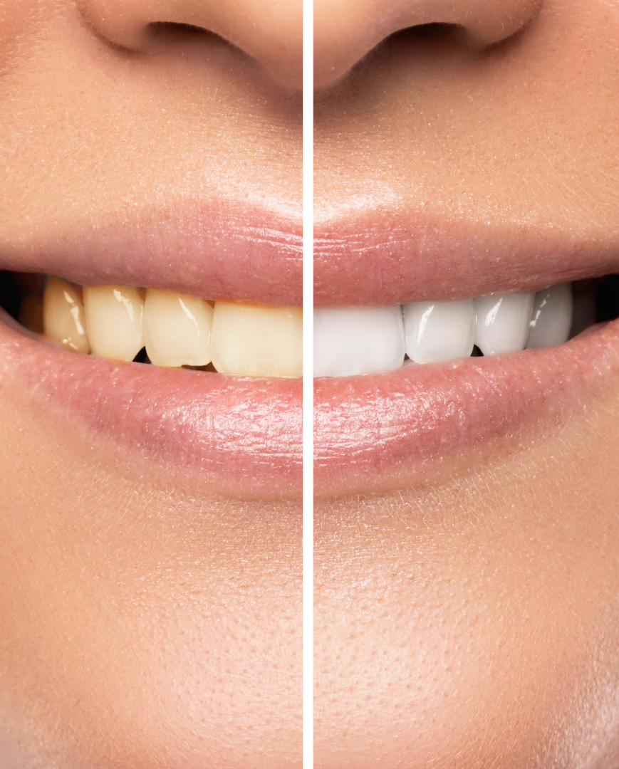 Teeth Whitening