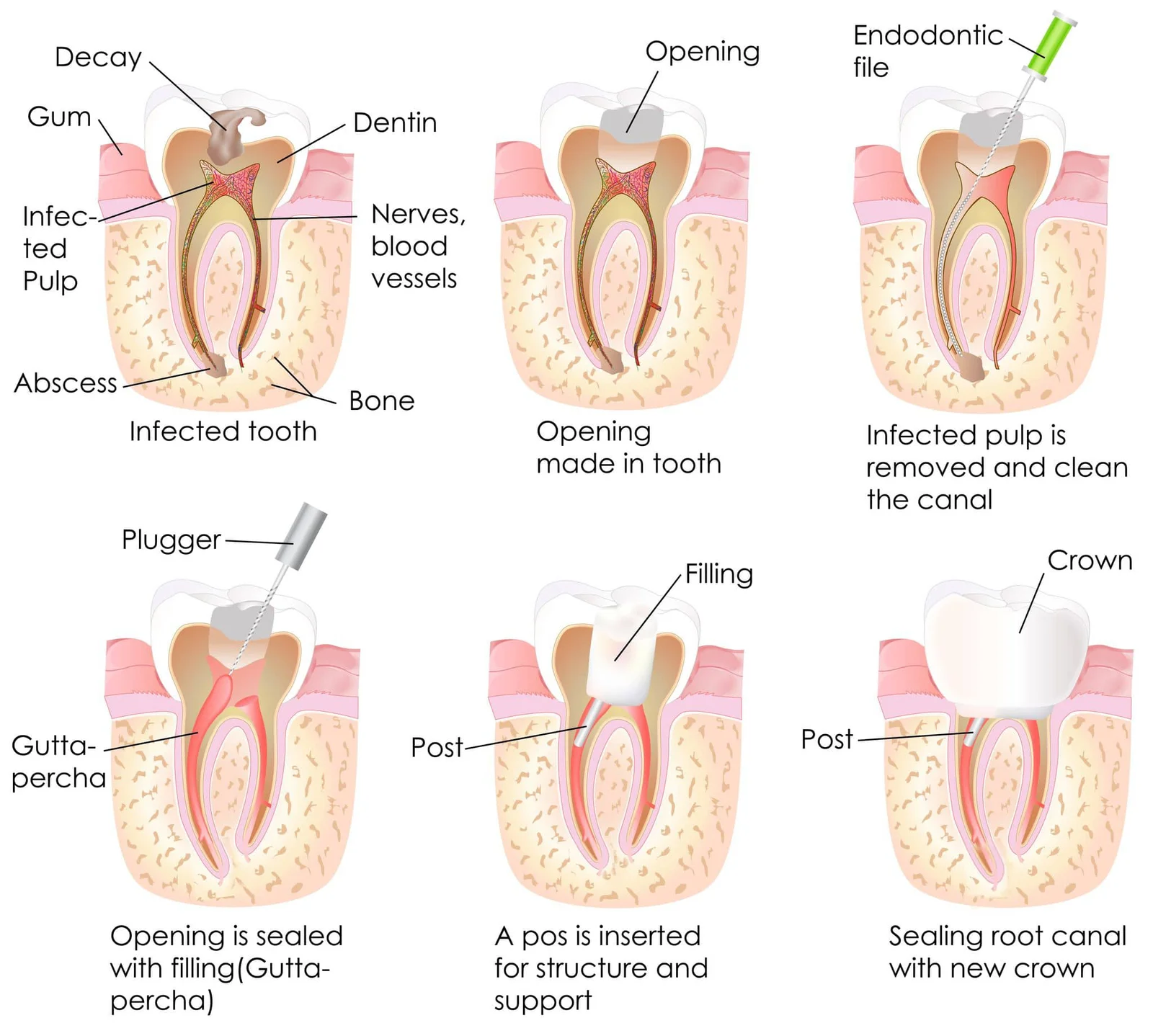 root-canal